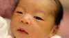 黄疸の症状や種類と黄疸になった赤ちゃんの治療方法 黄疸の症状や種類と黄疸になった赤ちゃんの治療方法