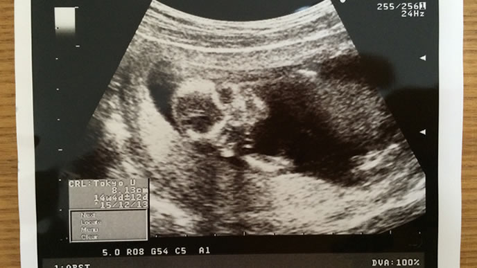 妊娠35週目のお腹の中のエコー写真